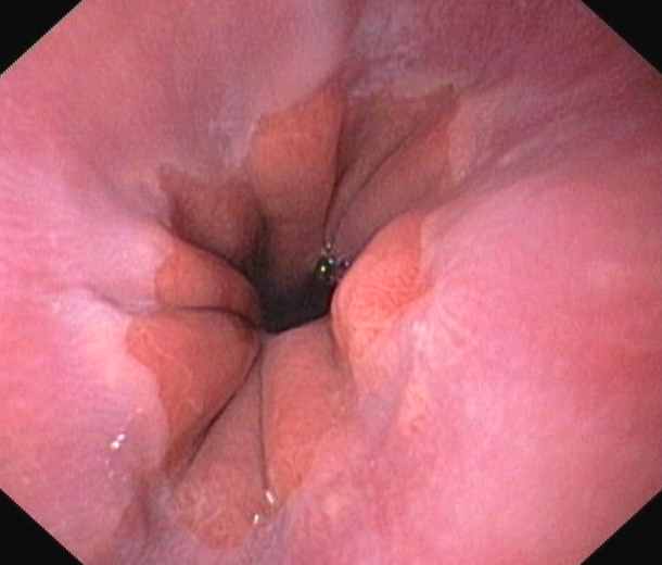 cardiac sphincter