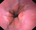 cardiac (lower esophageal) sphincter