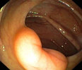 ileocecal valve (sphincter)