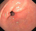 pyloric sphincter