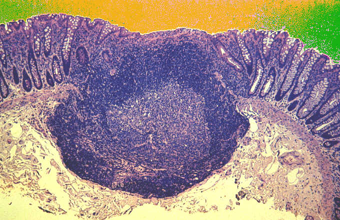 the lymph follicle