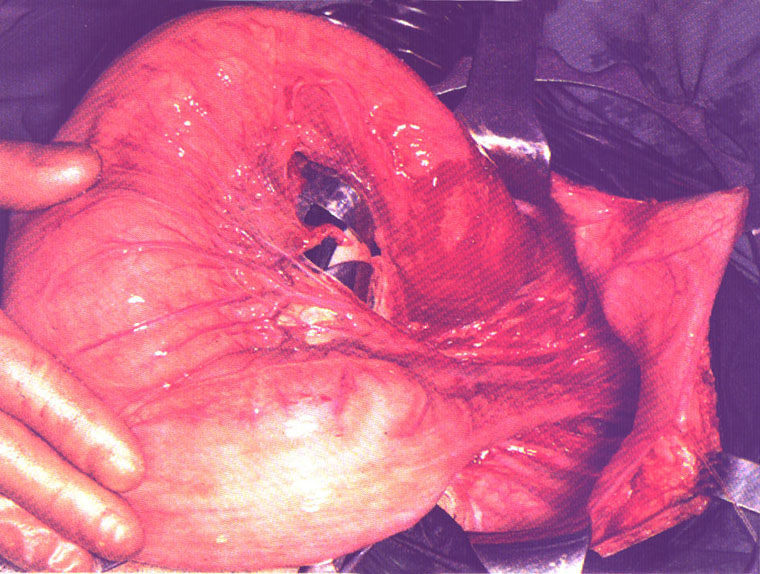 megacolon in Hirschsprung's at operation