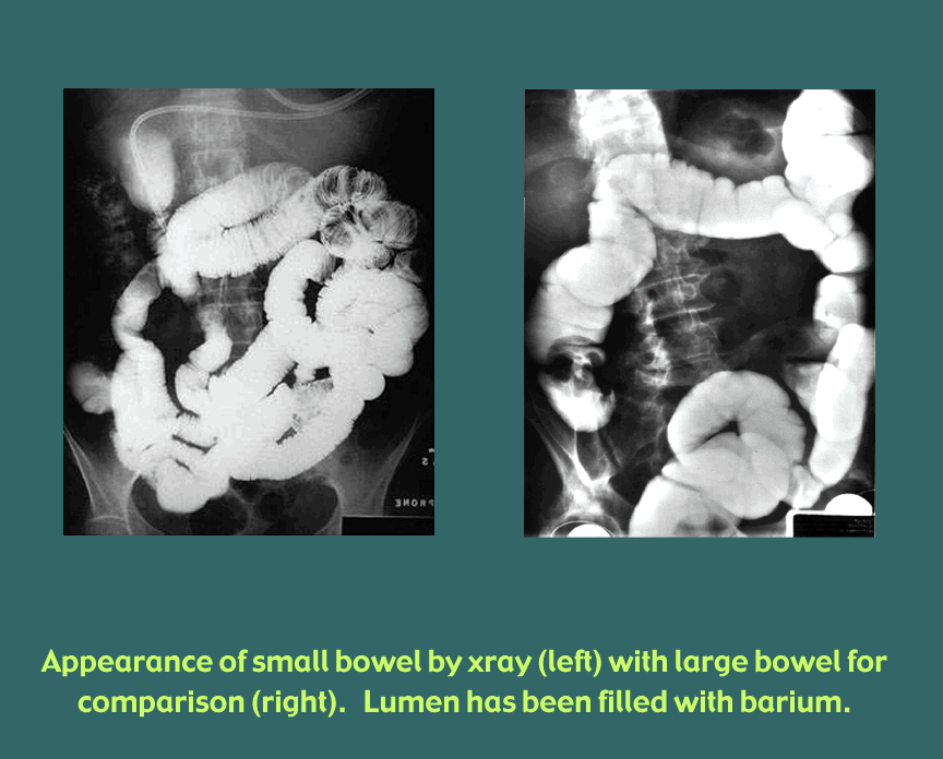 small and large bowel xray appearance